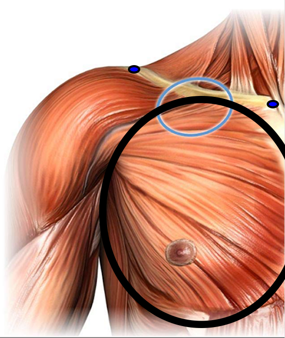 step2-pectoroplasty