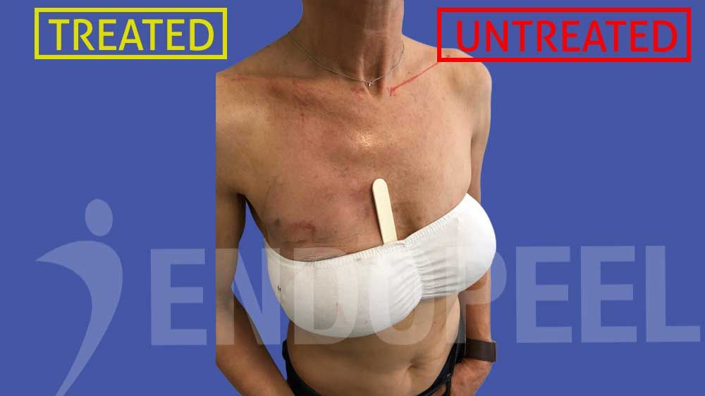 sporty female pectoroplasty