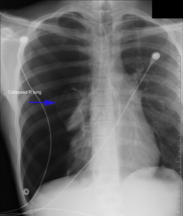 pneumothorax