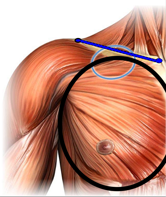 Step3-Pectoroplasty