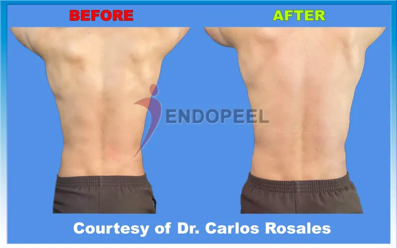 male trapezoplasty