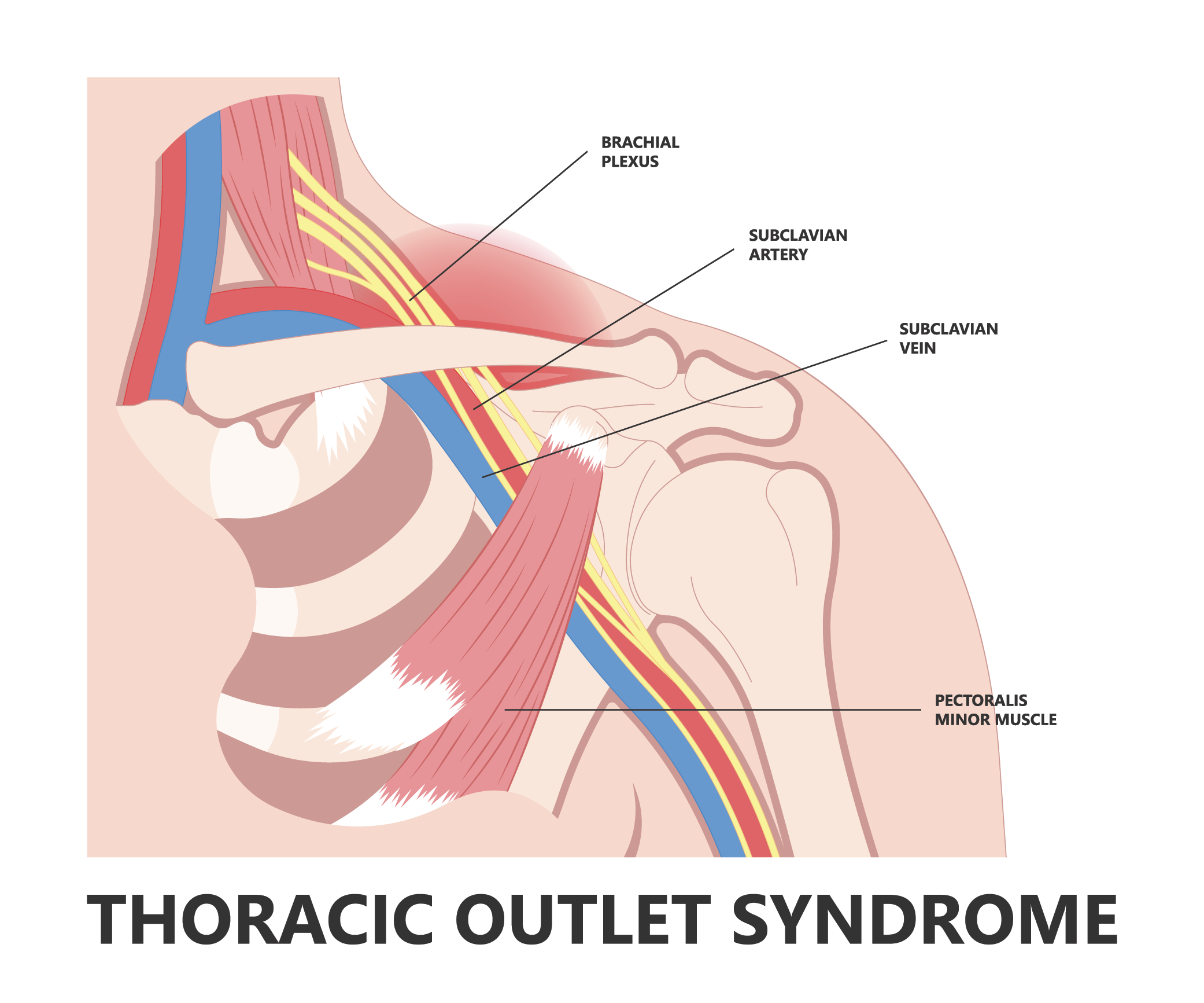 thoracic outlet syndrom