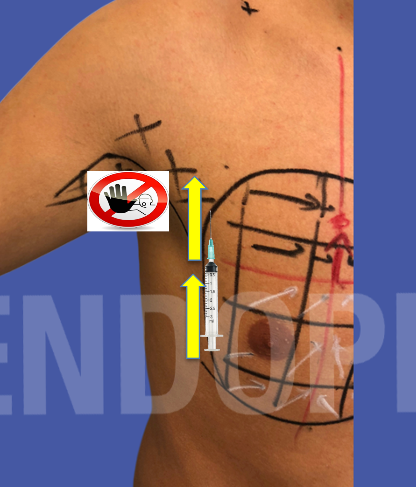 lateral tensors of M.TIZIANI