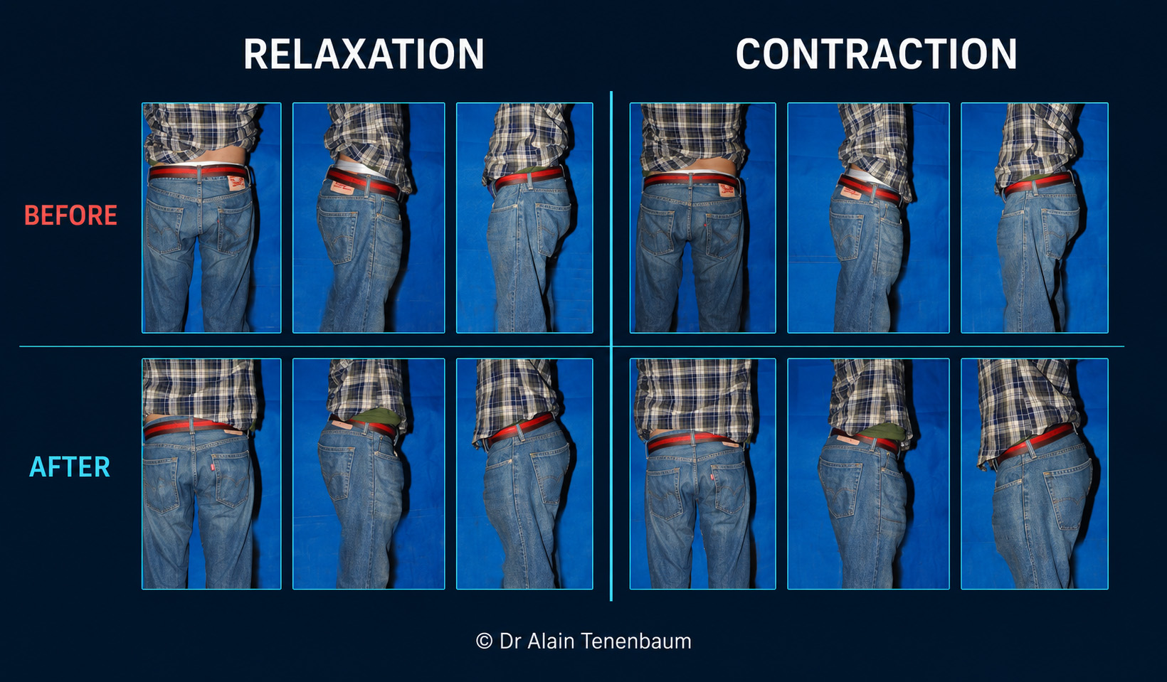Male gluteoplasty clinical comparison before and after treatment, showing rear and profile views in relaxation and contraction through clothing