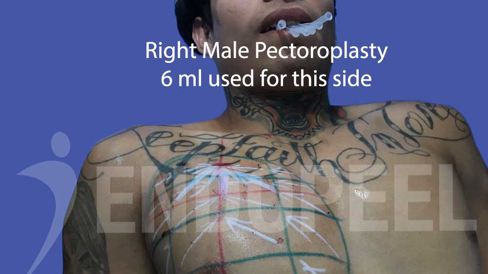 slide102-6 ml used per side