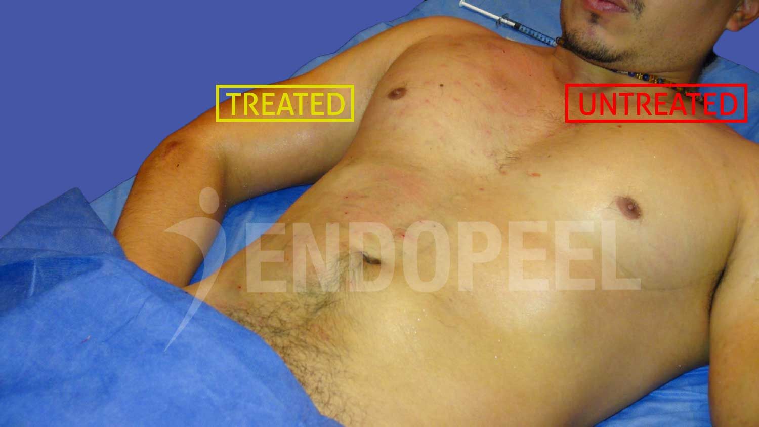 slide6-male-pectoroplasty