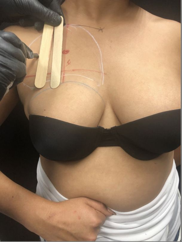 step 8a : 8a: Division of the pectoral working area into quadrants with verticales