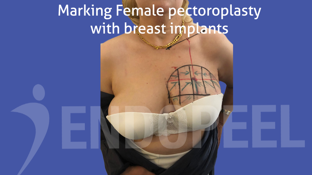 female with breast implant for pectoroplasty