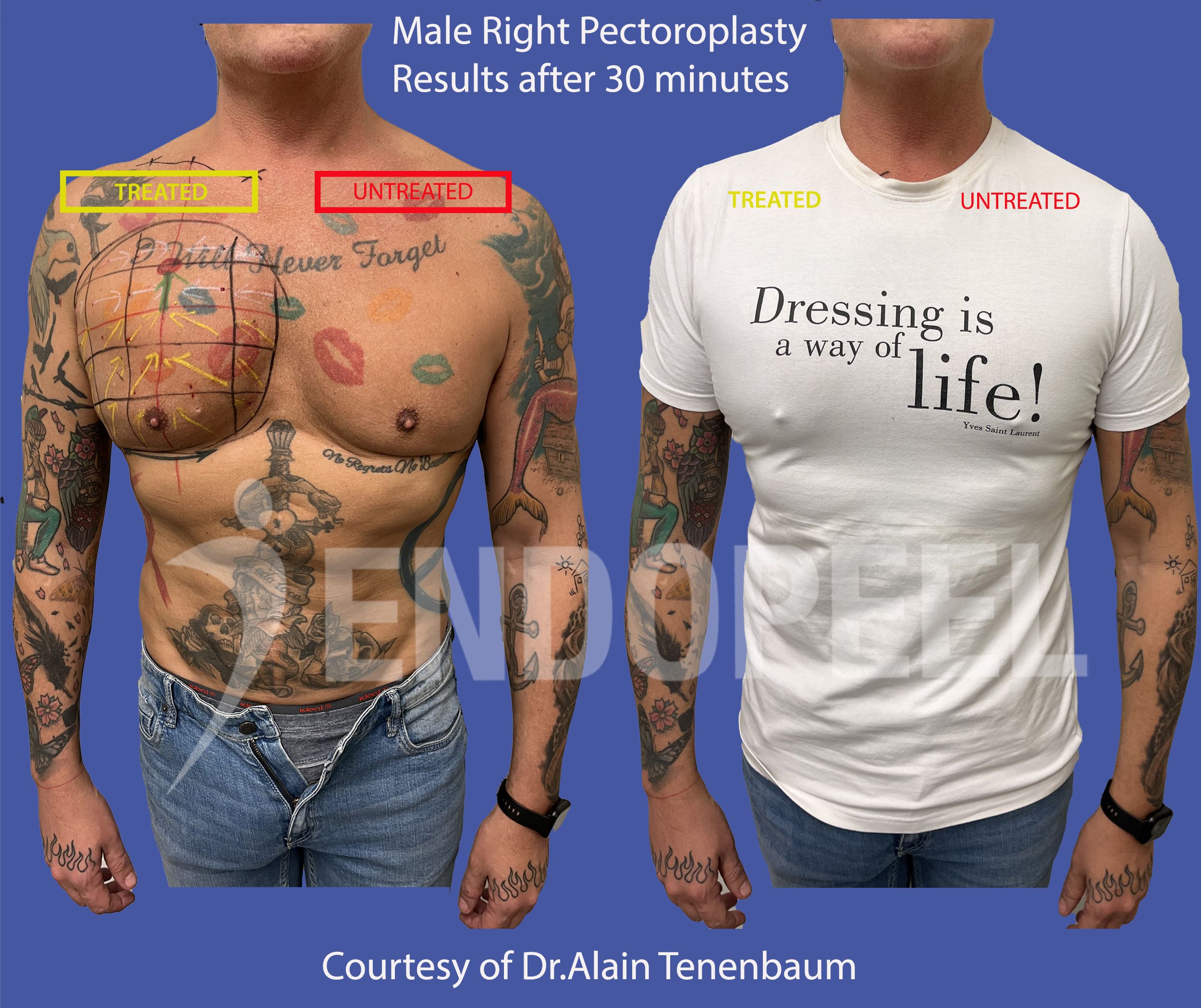 pectoroplasty-male-nude-tshirt
