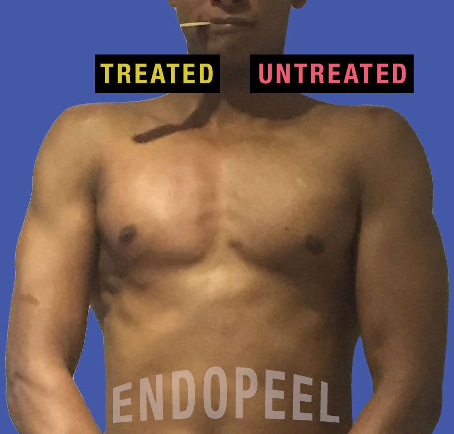 contraction male pectoral endopeel