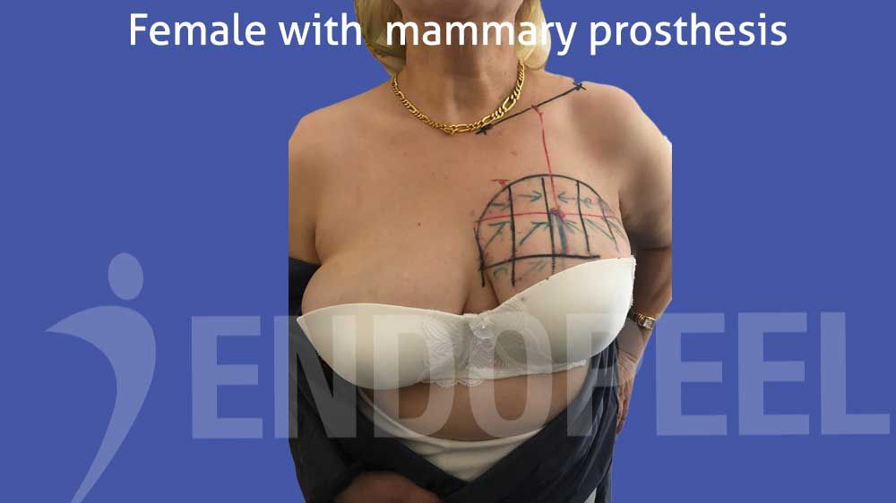 pectoroplasty on female having breast implants