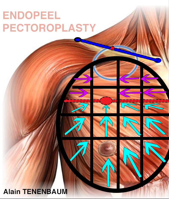 Step4-Pectoroplasty
