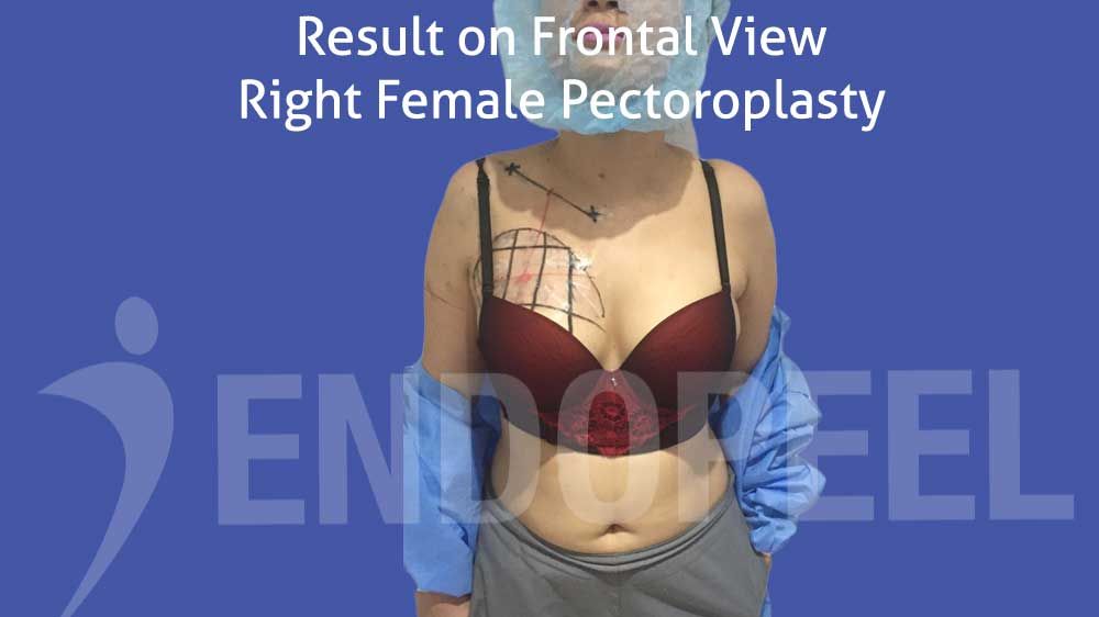 frontal view of female pectoroplasty right side