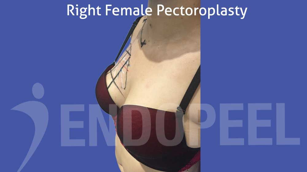 female-profil-view-right-pectoroplasty