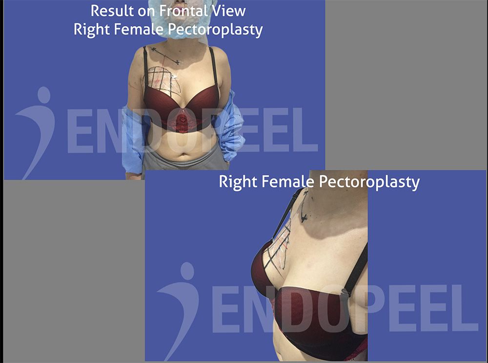 toboggan R female pectoroplasty