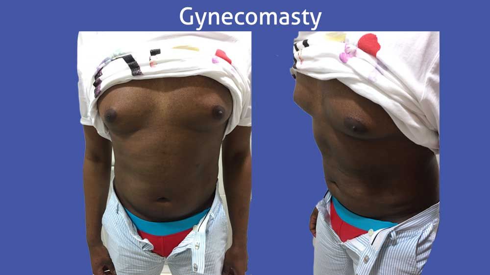 gynecomasty